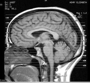 brain brain